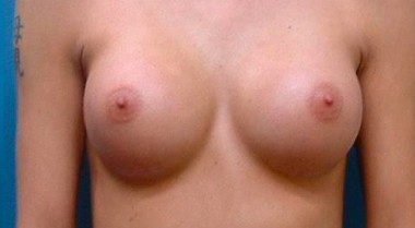 After Breast implant