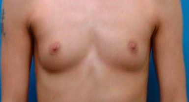 Before Breast implant