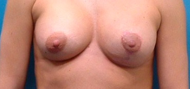 After breast asymmetry correction