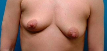 Before breast asymmetry correction
