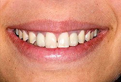 After Dental implant