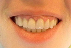 After Dental implant