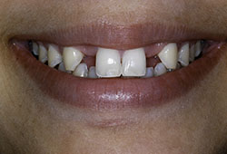 Before Dental implant
