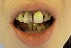 Before Dental implant