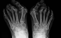 Before the Correction of Hallux
