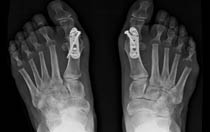 After the Correction of Hallux