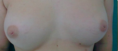 Before inverted nipple surgery