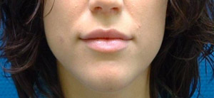 After lip shape correction