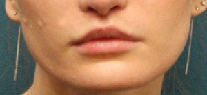 After lip shape correction