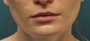 Before lip shape correction