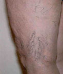 Before sclerotherapy