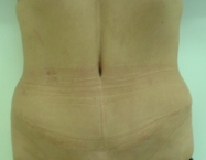 After Tummy Tuck surgery